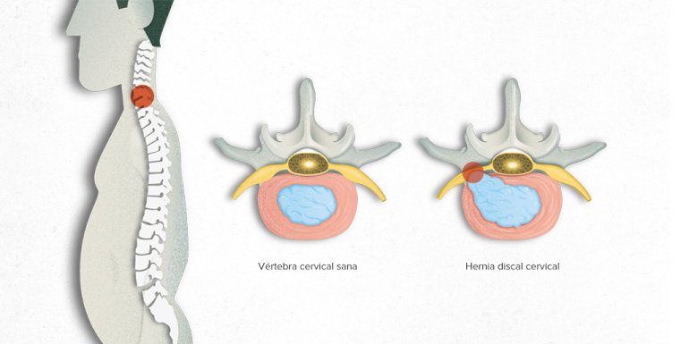 cervical disc herniation.jpeg, Jun 2023